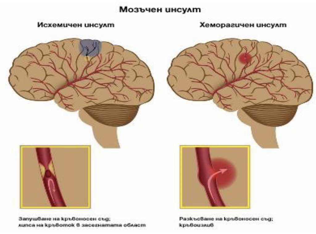 кислородна терапия мозъчен инсулт